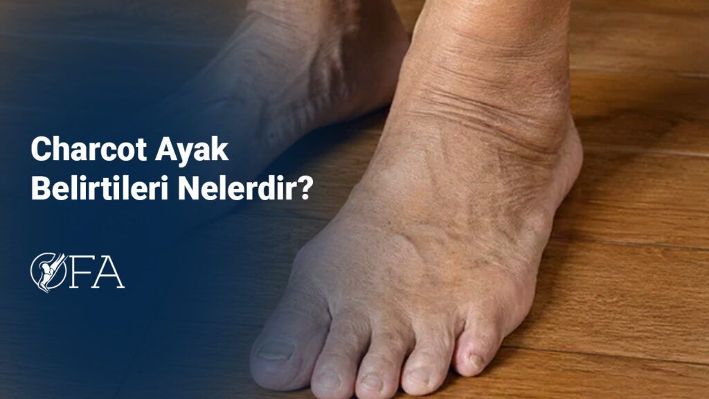 Charcot Ayak Belirtileri Nelerdir