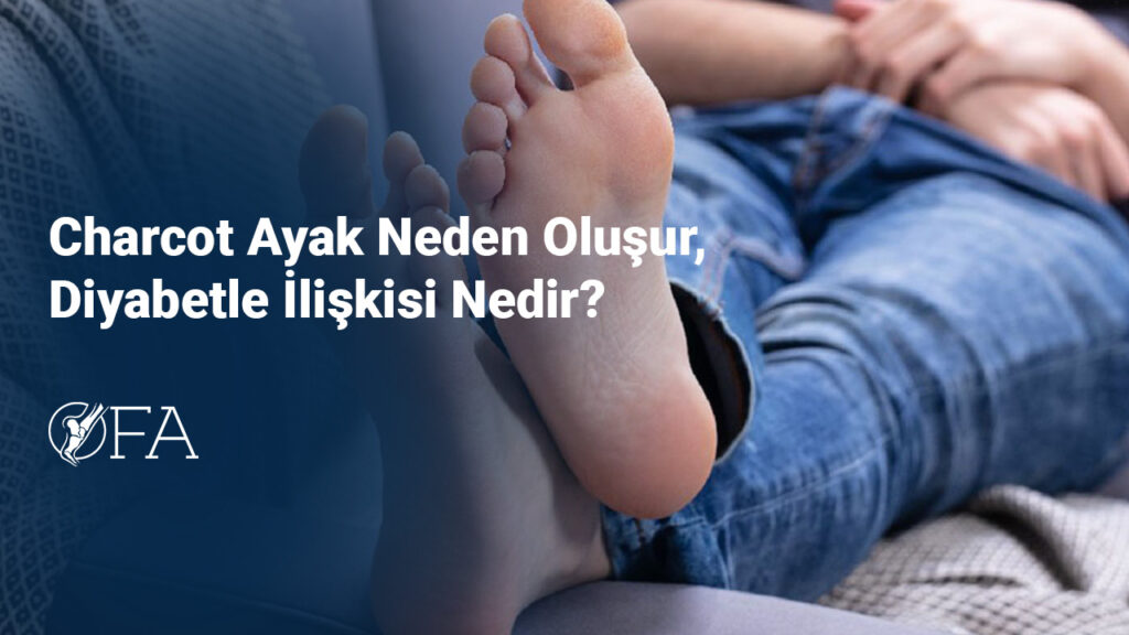 Charcot Ayak Neden Oluşur, Diyabetle İlişkisi Nedir?