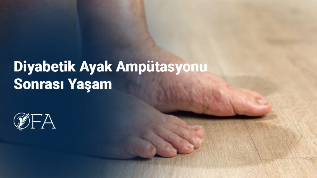 Diyabetik Ayak Ampütasyonu Sonrası Yaşam