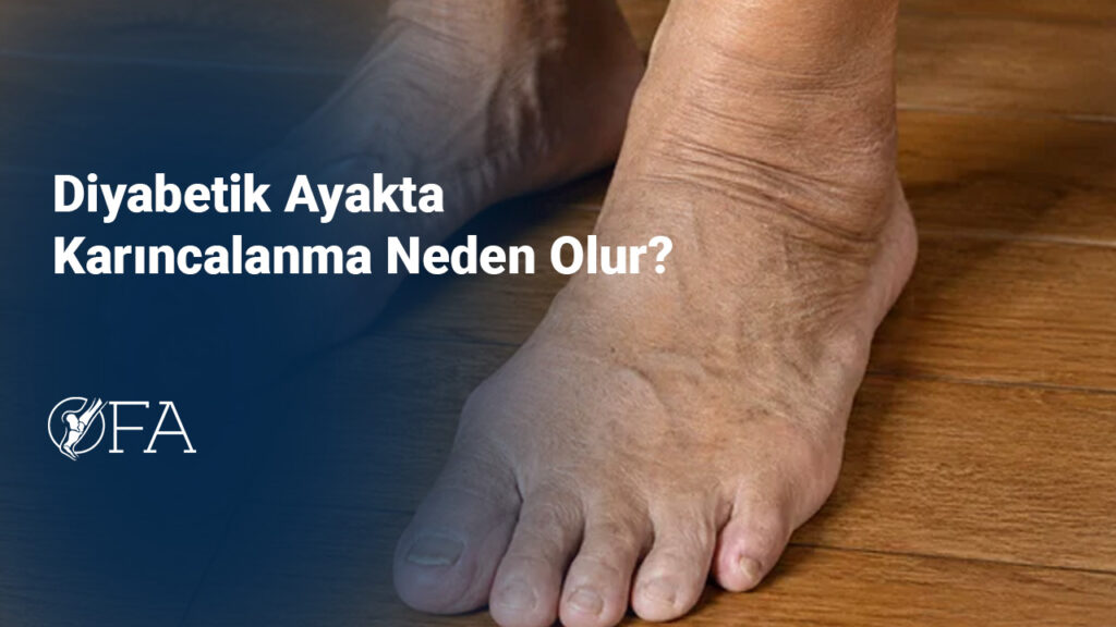 Diyabetik Ayakta Karıncalanma Neden Olur?